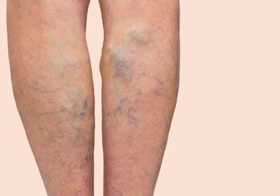 Varicose veins