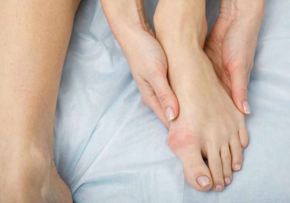 bunions hallux valgus